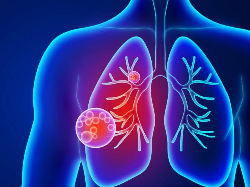 La gravedad de la neumonía depende de la extensión de pulmón que se haya visto afectada,