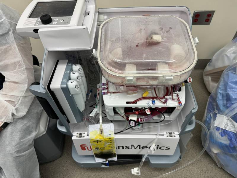 Una máquina de perfusión bombea sangre o un líquido oxigenado a los vasos sanguíneos de un órgano donado.