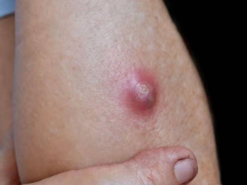 Autoridades sanitarias mantienen vigilancia ante el aumento de casos de miasis por gusano barrenador en Honduras y recomiendan reforzar la higiene y el cuidado de las heridas.