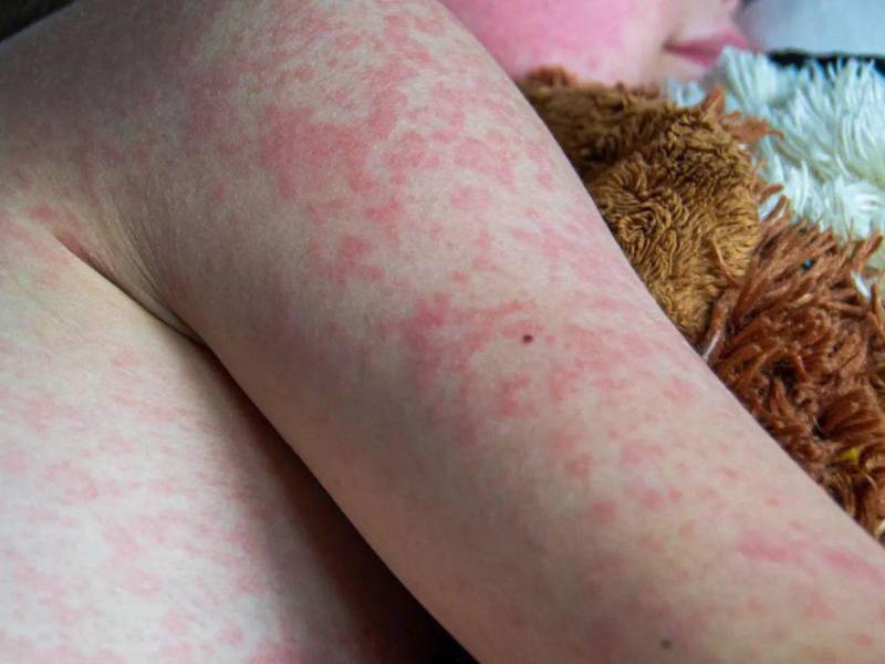 La OMS insta a los países miembros a fortalecer la vigilancia epidemiológica.