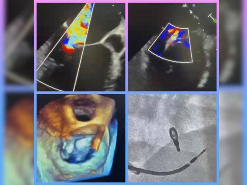 Tecnología MyClip permite reparar la válvula mitral sin cirugía a corazón abierto.