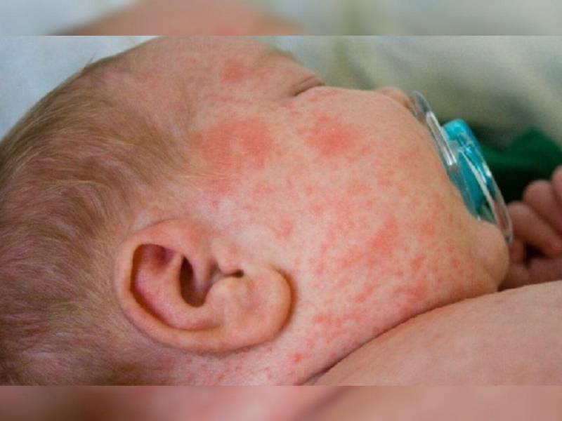 Un bebé con síntomas de sarampión recibe atención médica en una fotografía de referencia.