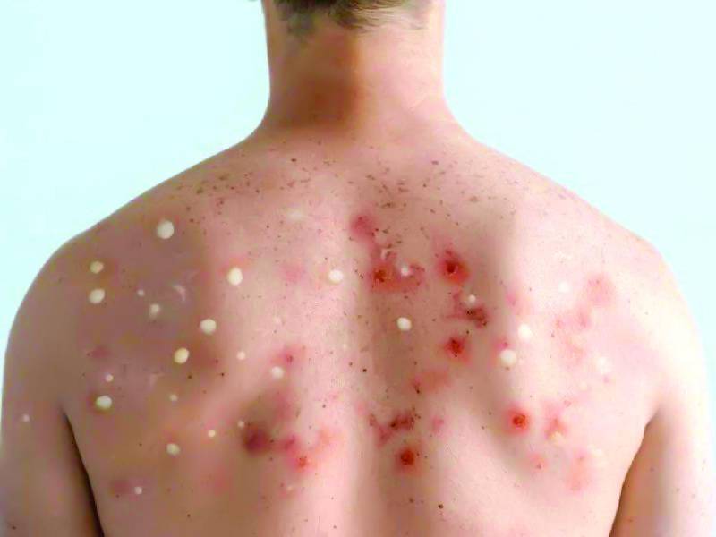 En este año no se han confirmado casos.