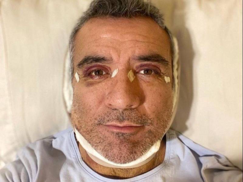 El que fuera presentador del reality show de Telemundo La casa de los famosos se hizo dos “arreglitos”: ritidoplastia y blefaroplastia.