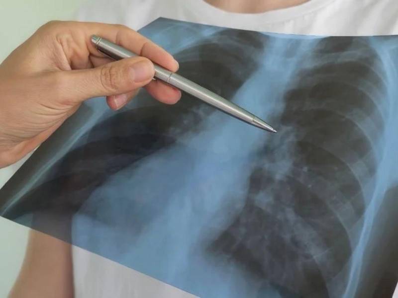 El diagnóstico de cáncer de pulmón del papa León XIV pone de relieve la importancia de identificar esta enfermedad en sus primeras etapas, cuando las posibilidades de tratamiento con intención curativa son mayores. En el caso del pontífice, de 71 años, un nódulo en el pulmón derecho fue detectado durante una revisión médica de rutina y, tras confirmarse que era maligno, fue extirpado con éxito en el Hospital Gemelli de Roma, Italia.