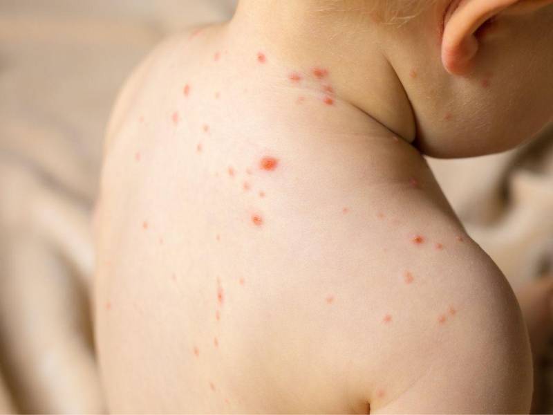 El sarampión es una enfermedad viral altamente contagiosa.