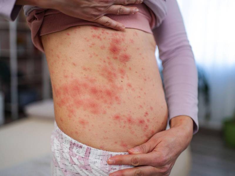 Hay alerta sanitaria en la región de América por sarampión.