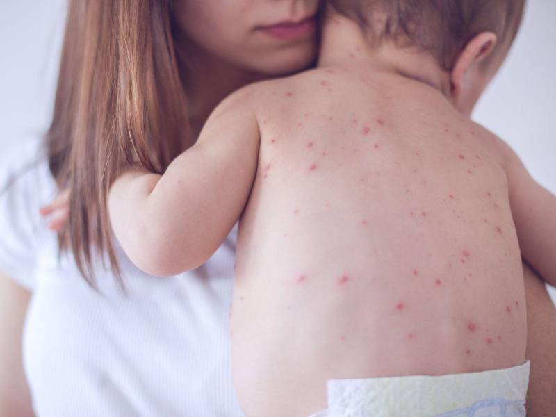 Los niños son el grupo más vulnerable al sarampión, por esta razón la vacunación temprana es fundamental para protegerlos