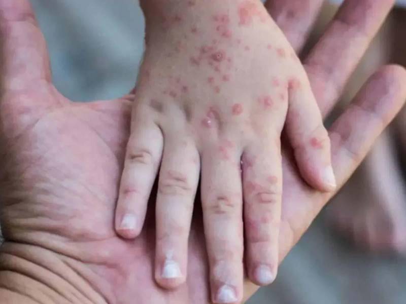 Honduras mantiene vigilancia epidemiológica en fronteras ante riesgo de sarampión por brotes en la región, especialmente en Guatemala.