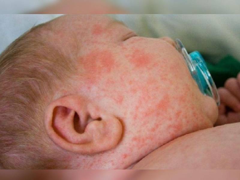 Un bebé con síntomas de sarampión recibe atención médica en una fotografía de referencia.