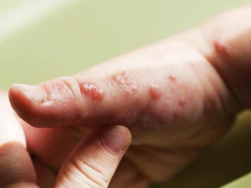 Caso de viruela del mono en Honduras