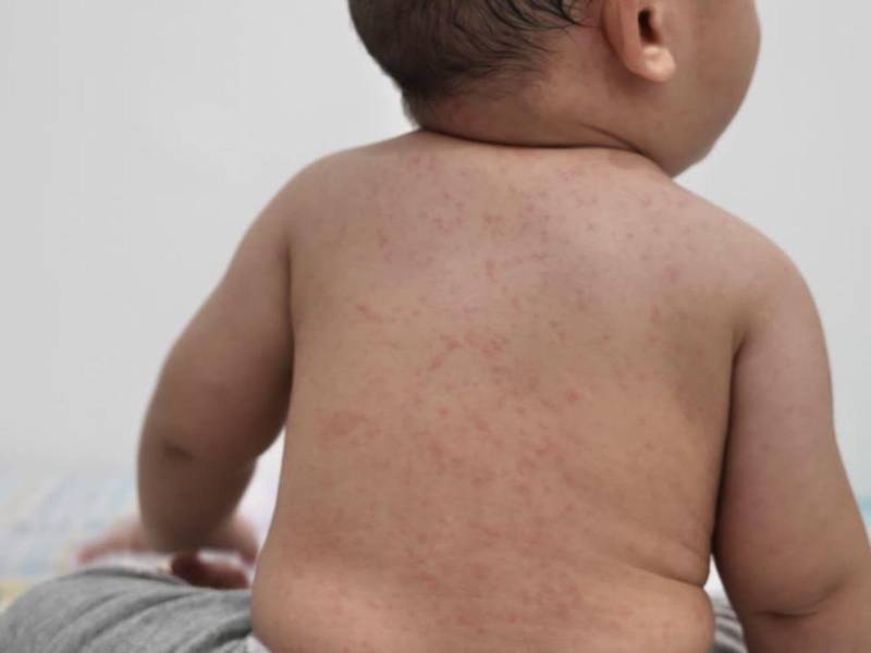 El sarampión cobró la vida de dos bebés en Guatemala: uno de dos meses y otro de ocho meses.