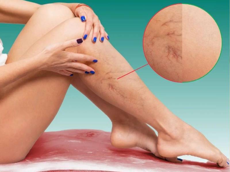 Es una afección grave porque el coágulo puede desprenderse, viajar a los pulmones y causar una embolia pulmonar, una condición potencialmente mortal.