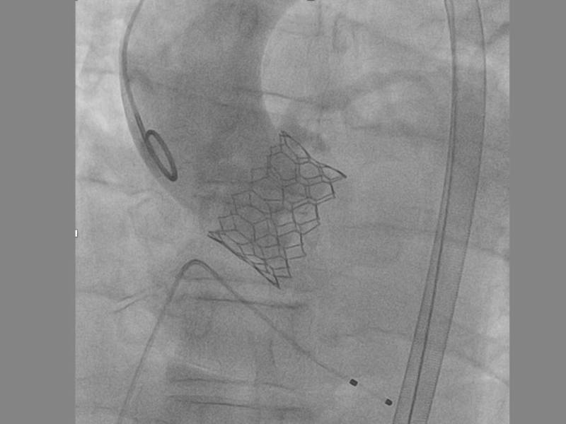 Imagen fluoroscópica obtenida durante el procedimiento que muestra la correcta liberación y expansión de la prótesis valvular transcatéter 35 mm, resultado de una planificación anatómica precisa y del trabajo coordinado del Heart Team.