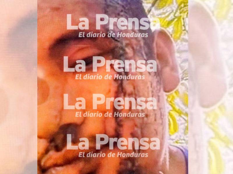 Exclusiva: Fotografía de Esteban Ferrera, alias El Diablo, herido