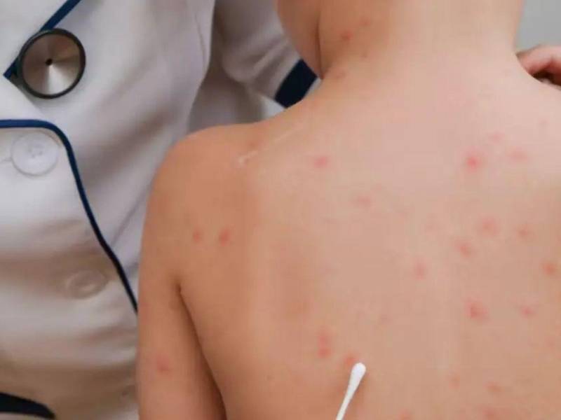 Un médico realiza chequeo médico a niño con síntomas de sarampión.