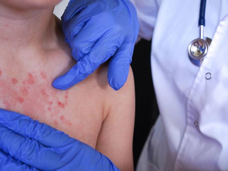 Una persona con síntomas de sarampión recibe atención médica en una fotografía de referencia.