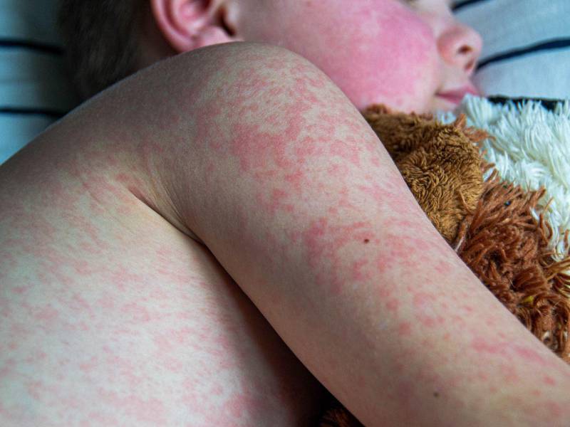 El sarampión es una enfermedad viral altamente contagiosa que puede causar fiebre, tos, erupción en la piel y complicaciones graves en personas no vacunadas.