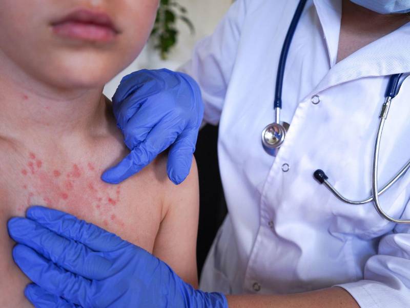 Un niño con síntomas de sarampión es atendido en un centro médico en una fotografía de referencia.