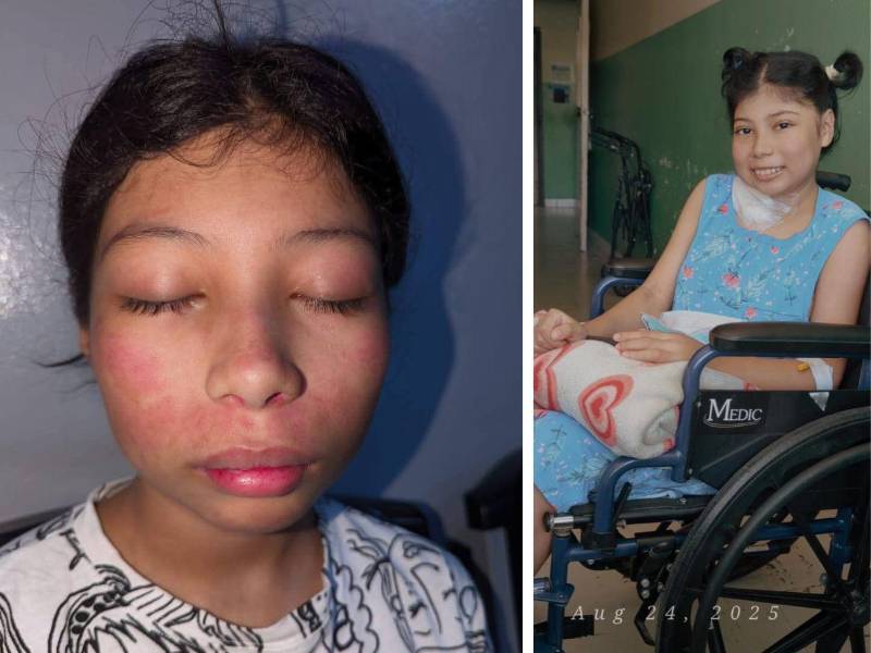 La niña enfrenta las huellas visibles del lupus en su rostro (izquierda) y continúa su lucha desde una silla de ruedas tras recibir tratamiento médico. Su estado físico se ha deterioro a causa de la enfermedad autoinmune.