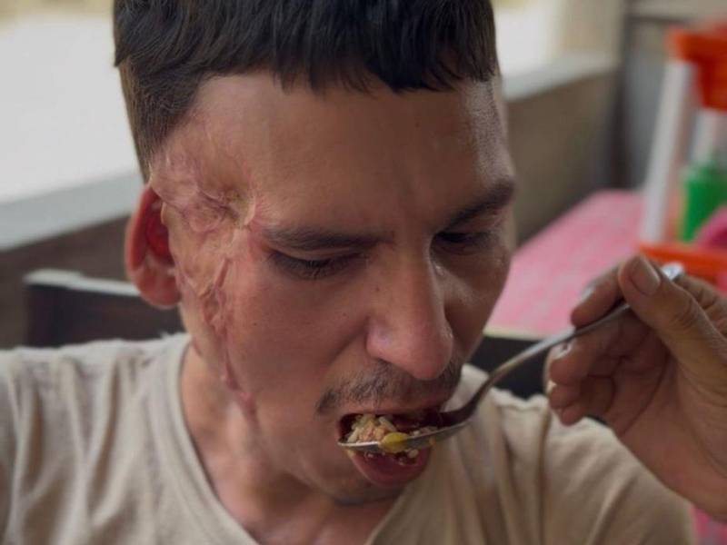 Gerson requiere de la ayuda incondicional de su familia para todo, incluso para comer. Llora al verse sin sus manos, y por la impotencia de haber perdido su independencia.