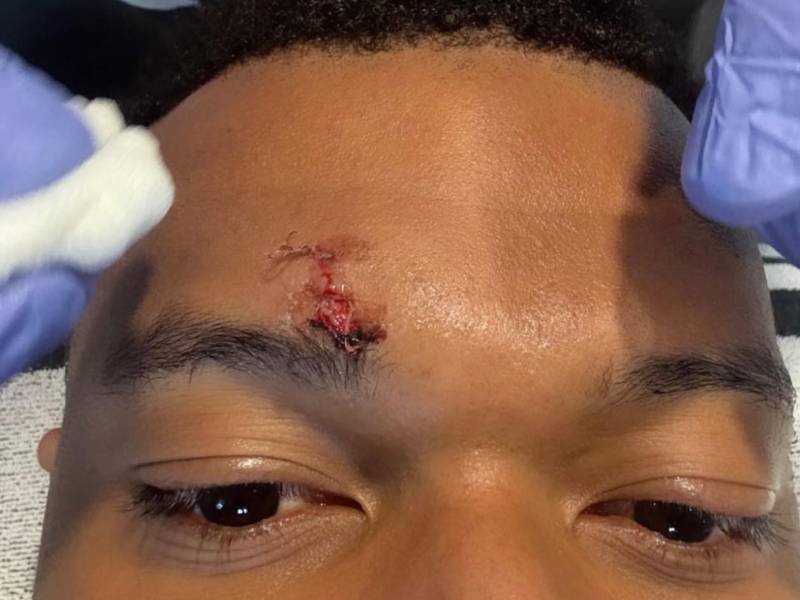 Mbappé no entrenó con el Real Madrid y recibió unas puntadas en la frente por la herida que sufrió ante Girona.