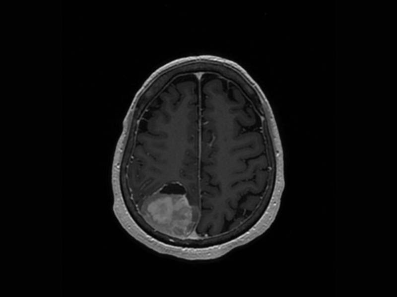 Fotografía referencial de un tumor cerebral.