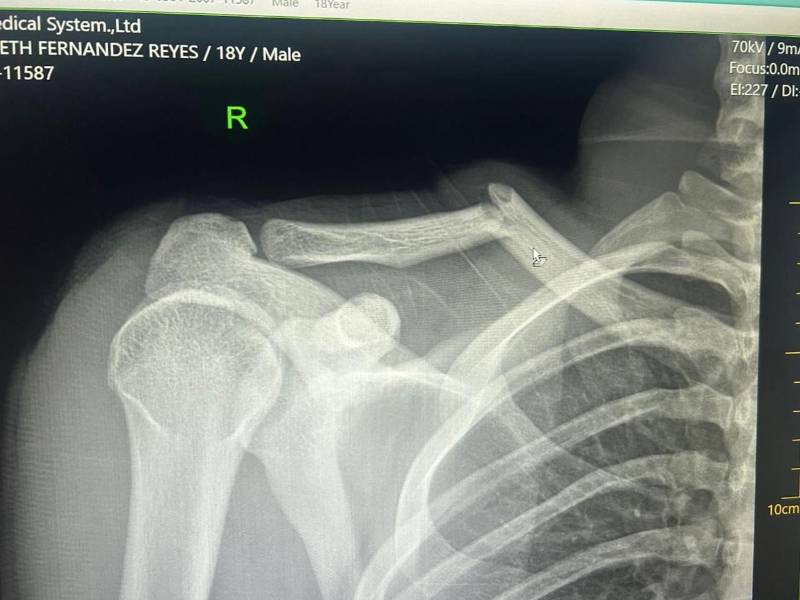 Los Rayos-X que le realizaron a Jaylor Fernández tras el partido ante el Victoria.