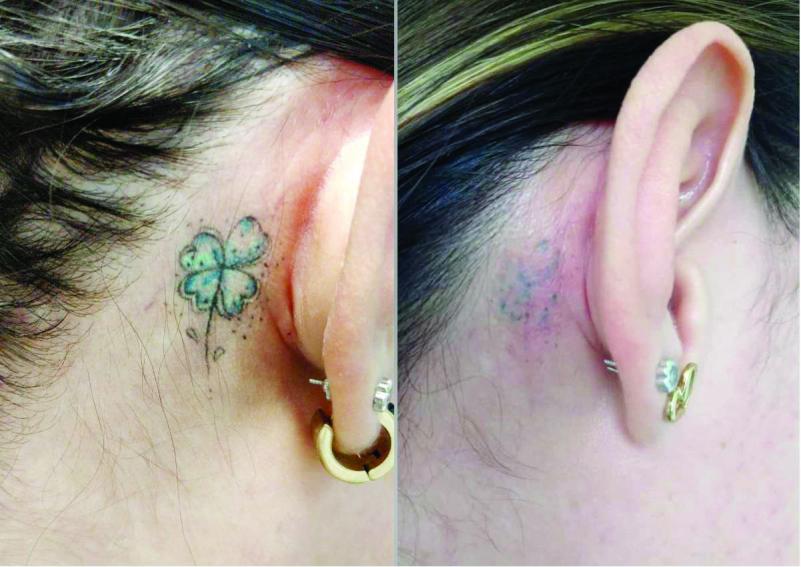 ¿Cómo deshacerse de un tatuaje que ya no te gusta?