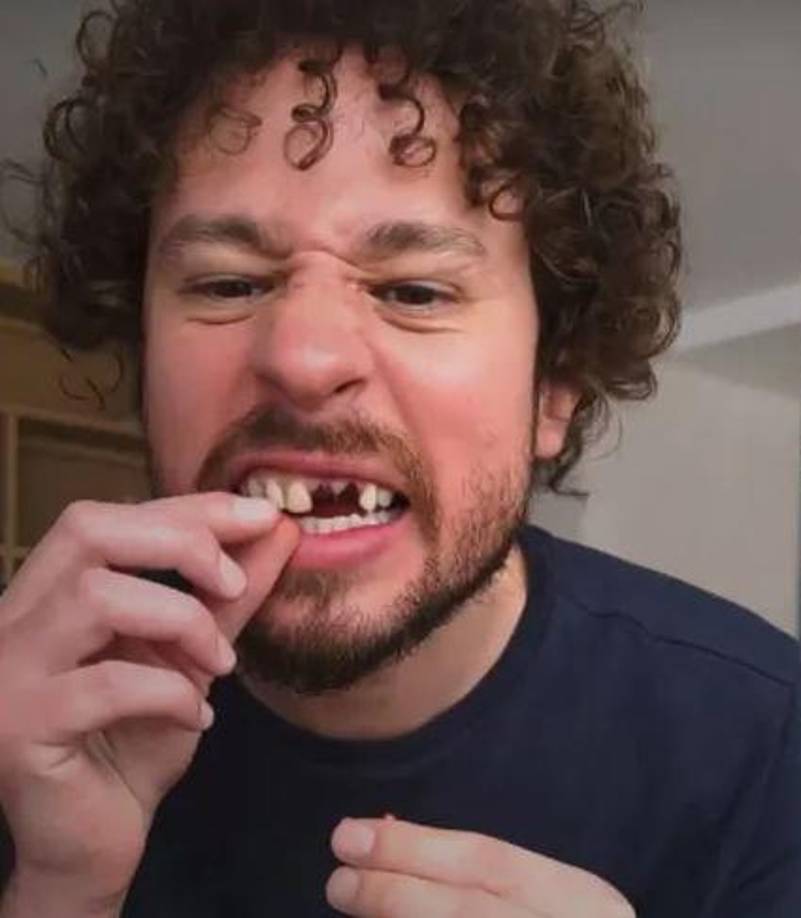 Posteriormente, se arrancó los dos dientes frontales.