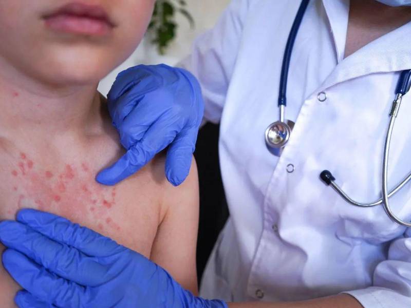 Aunque no se reportan muertes por la enfermedad, las autoridades alertan sobre complicaciones como neumonía, problemas respiratorios y daños neurológicos.