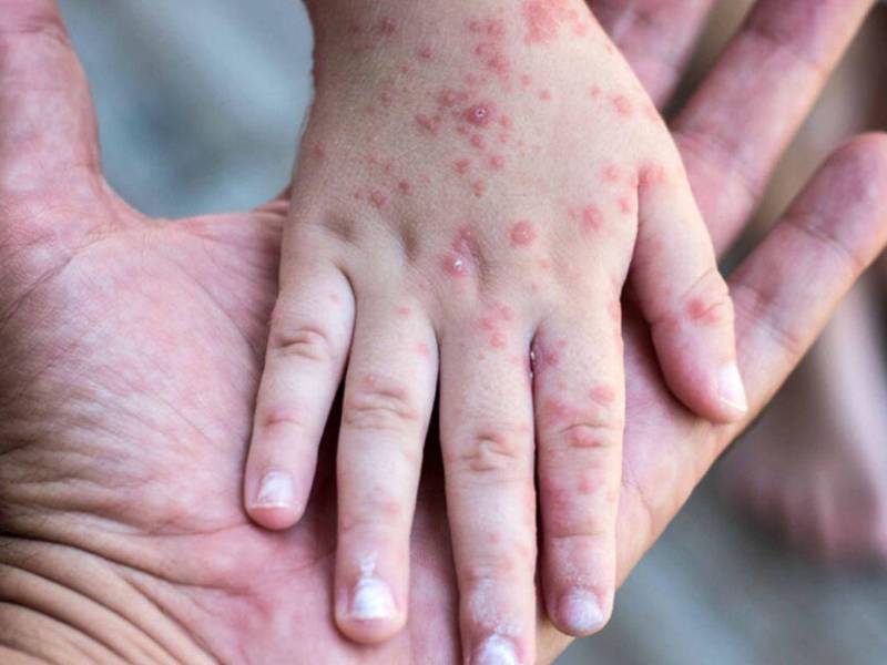 Salud detalló que los contactos identificados del paciente permanecen bajo vigilancia epidemiológica y seguimiento clínico.
