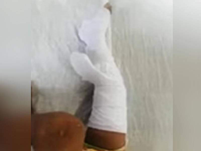 El menor ya fue intervenido quirúrgicamente, pero necesita más cirugías.