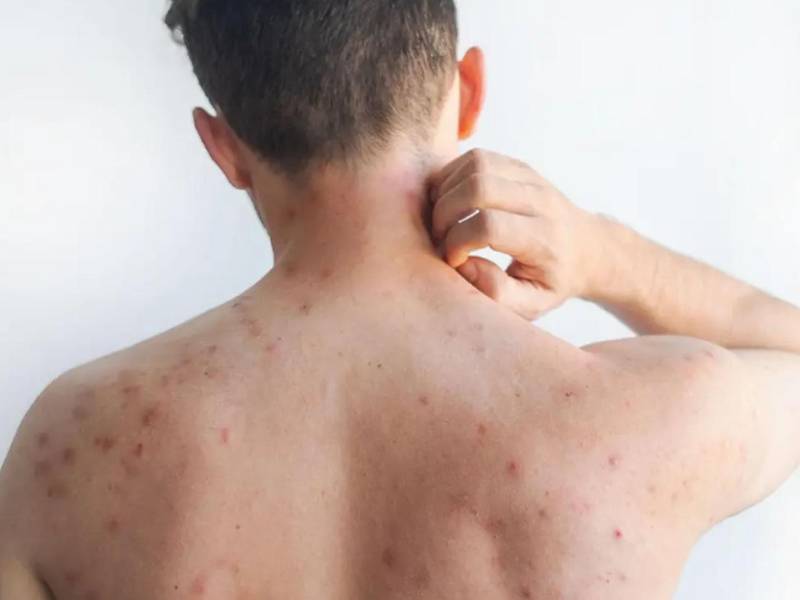 Las autoridades de salud insistieron en que la <b>vacunación</b> continúa siendo la medida más eficaz para prevenir contagios. Imagen referencial.