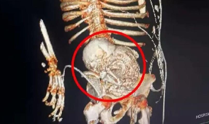 Una mujer con un feto calcificado desde hace 30 años muere en una operación