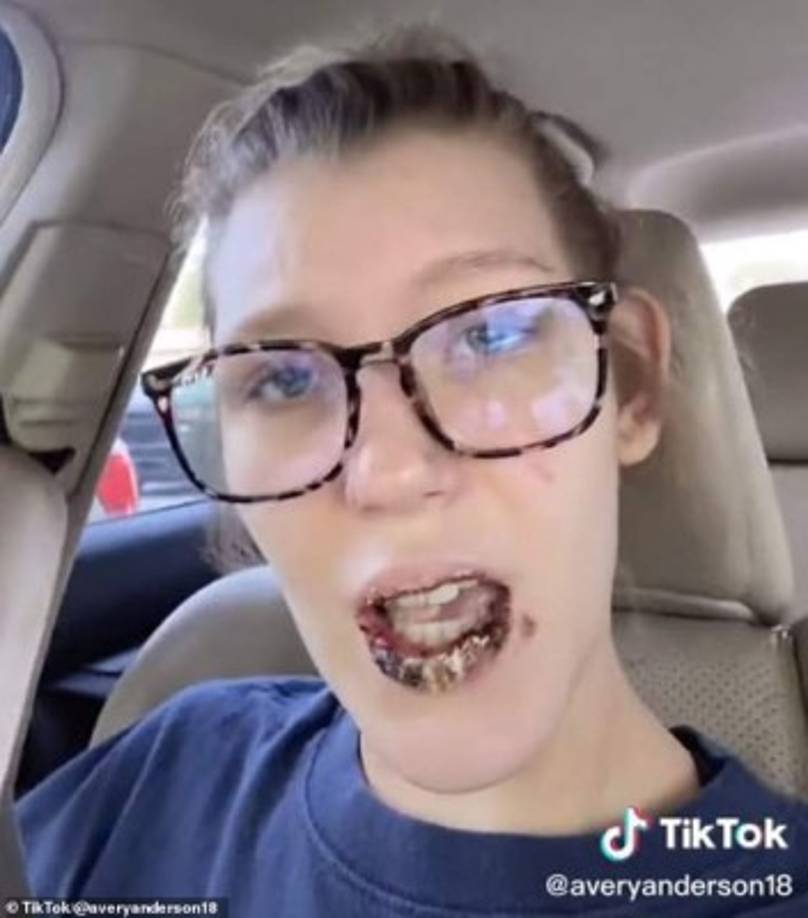 La chica compartió en TikTok que tuvo posible efecto secundario de la enfermedad, el cual se combinó con otra reacción adversa de un medicamento contra el acné que ella tomaba, dando como resultado un hongo que provocó que sus labios se tornaron oscuros con dolorosas costras amarillentas. <br/><br/>