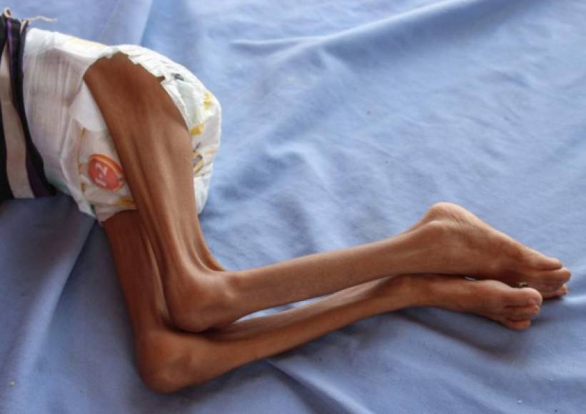 Más de cinco millones de niños están amenazados de hambruna en Yemen, denunció el miércoles la ONG Save the Children, en un contexto de guerra y de precios cada vez mas altos de alimentos y carburantes.