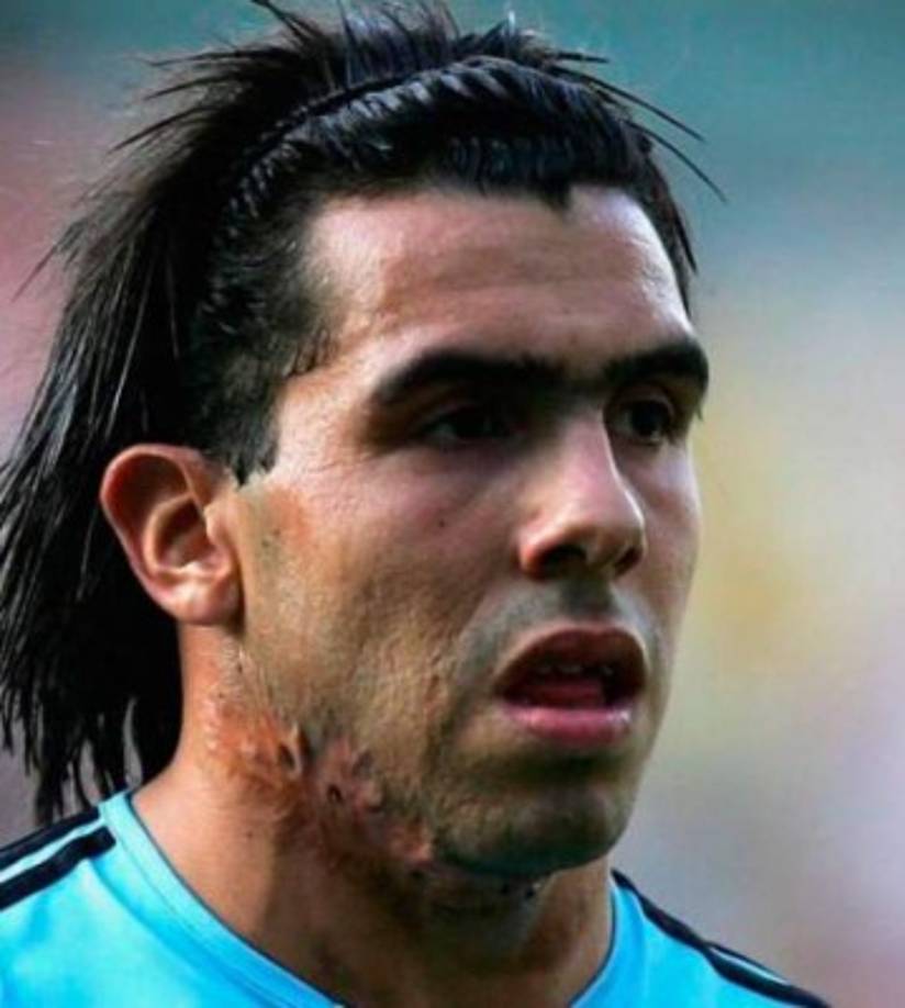 Carlos Tevez es considerado el Jugador del Pueblo, se ha sometido a diferentes curigias estéticas.