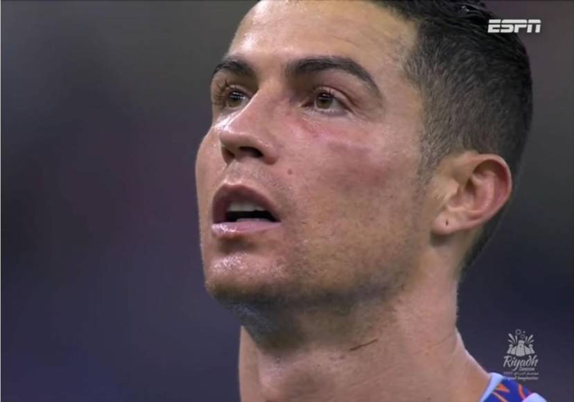 Así le quedó el pómulo a Cristiano Ronaldo tras el duro golpe que le dio Keylor Navas.