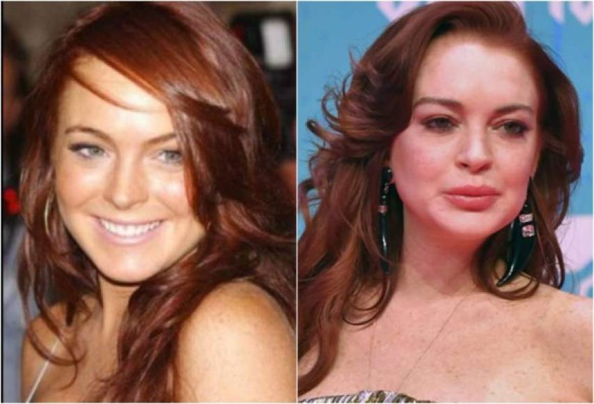 Para Lindsay Lohan no solo las sustancias tóxicas se convirtieron en su adicción, la actriz cambió su rostro con las cirugías, a sus 33 años luce como una mujer mucho mayor.