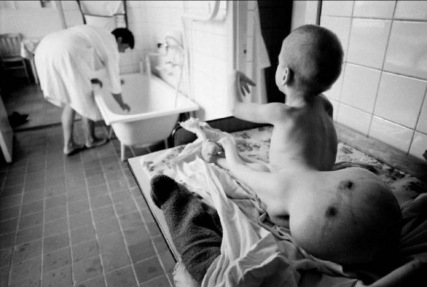 Sus retratos reflejan las víctimas que todavía sufren las secuelas de la radiación que dejó Chernobyl.