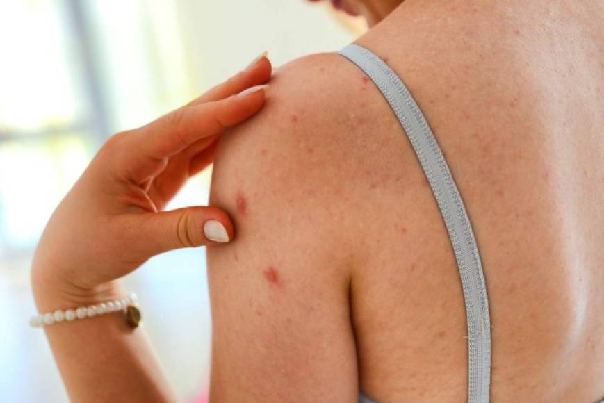 Cómo usar: mezclar el polvo de piedra de alumbre con 2 claras de huevo y aplicar en la cara durante 20 minutos. <br/><br/>Después se debe lavar con agua tibia e hidratar la piel con una crema específica para la piel con acné.<br/><br/><br/>