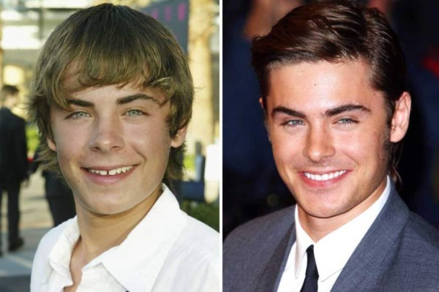 Zac Efron.<br/>Reconocido por producciones como 'High School Musical', el actor tenía una separación en sus dientes, en el 2004, mientras que para el 2019 ya no la tenía, lo cual hizo que recibiera múltiples elogios de sus seguidores.