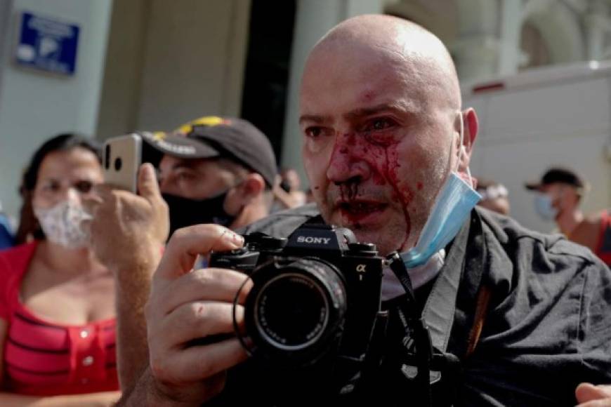 AP photographer, Spanish Ramon Espinosa, is seen with injuries in his face while covering a demonstration against Cuban President Miguel Diaz-Canel in Havana, on July 11, 2021. - Thousands of Cubans took part in rare protests Sunday against the communist government, marching through a town chanting 'Down with the dictatorship' and 'We want liberty.' (Photo by Adalberto ROQUE / AFP)