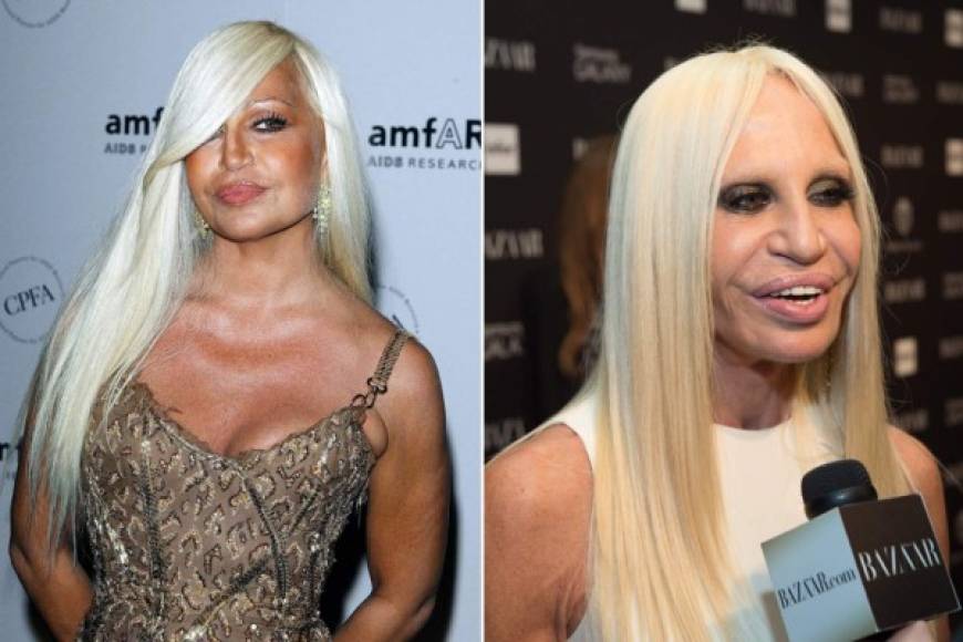 La diseñadora de modas Donatella Versace impactó luego de haberse hecho esta cirugía.