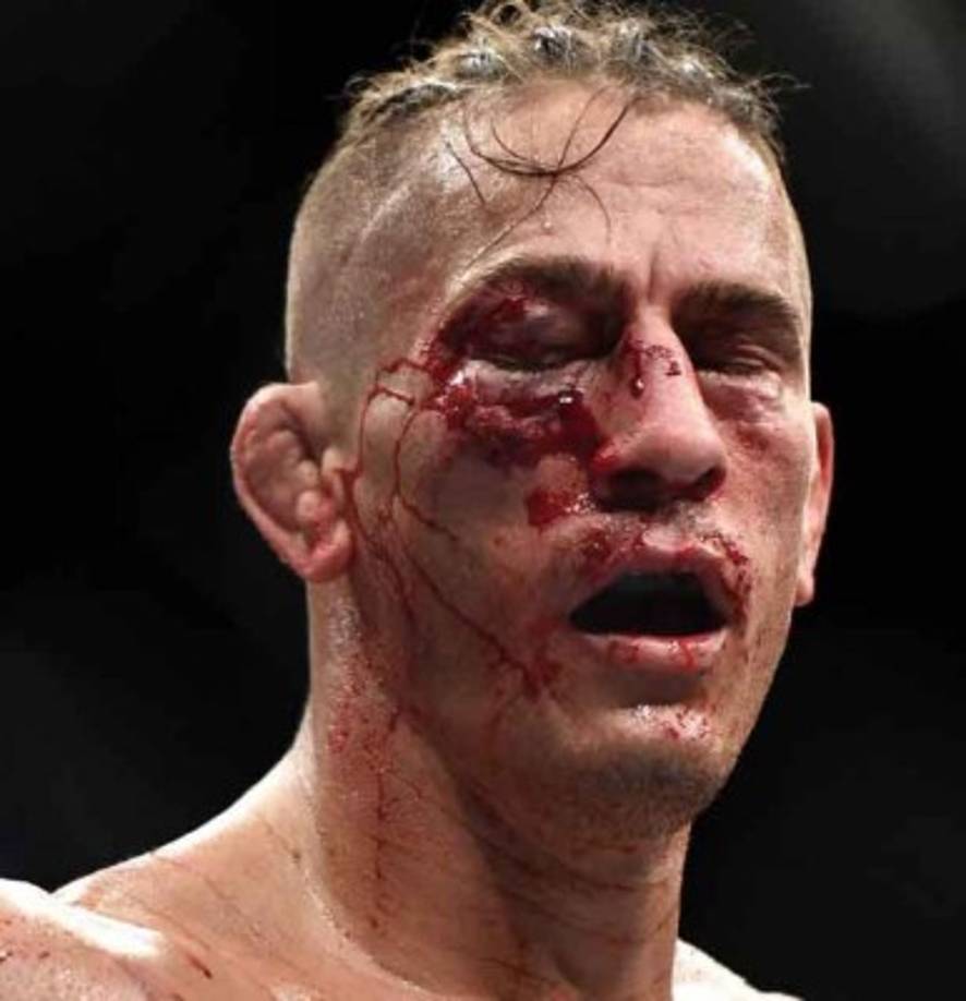 Niko Price erminó con un corte profundo en el ojo que, tras ser revisado por el médico, le impidió continuar luchando.