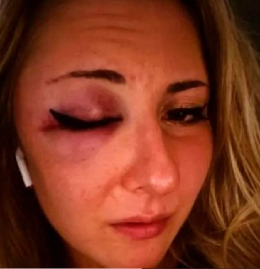 Dos de ellos la sujetaron y el tercero la golpeó en la cara, dejándola con un ojo morado, contó. La muchacha afirmó que una docena de personas vieron la escena pero nadie intervino.<br/><br/>