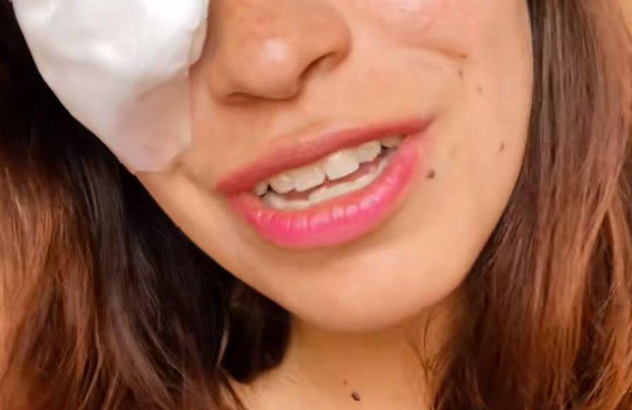 De acuerdo con la fan, en el concierto se utilizó pirotecnia, lo cual un fragmento de eso le cayó en el ojo derecho, ya que se encontraba muy cerca del escenario.