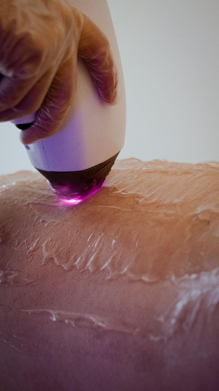 ¿Belleza sin límites? Usan grasa de donantes fallecidos para esculpir cuerpos