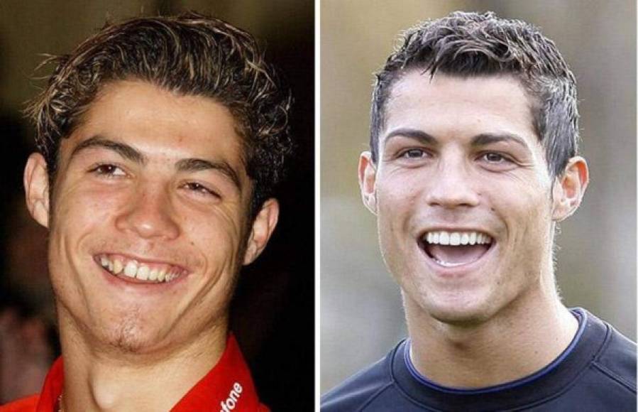 Cristiano Ronaldo.<br/>El jugador de la Juventus F. C. no siempre tuvo una sonrisa bonita. A Ronaldo le realizaron un tratamiento de ortodoncia para recuperar el espacio del diente ausente y recolocar los otros dientes en su sitio.